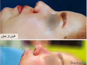 نمونه عمل بینی دکتر حمیرا رشدی (2)