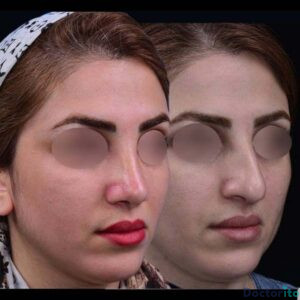 نمونه عمل بینی دکتر روزینا بشارتی زاده (1)