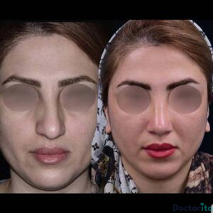 نمونه عمل بینی دکتر روزینا بشارتی زاده (2)