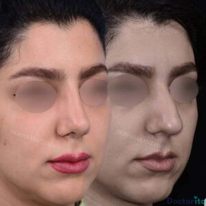 نمونه عمل بینی دکتر روزینا بشارتی زاده (4)