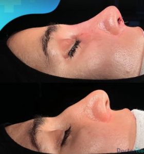 نمونه عمل بینی دکتر رضا کریمی (2)