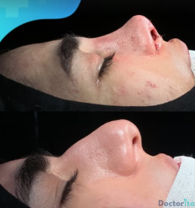 نمونه عمل بینی دکتر رضا کریمی (3)