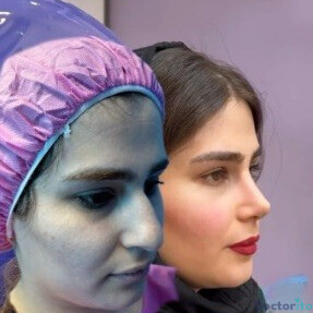 نمونه عمل بینی دکتر رضا کریمیان (2)