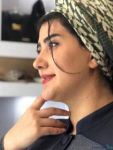 نمونه عمل بینی دکتر شبنم حاج علیپور (2)
