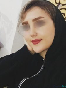 نمونه عمل بینی دکتر شبنم حاج علیپور (3)