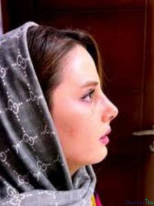 نمونه عمل بینی دکتر شبنم حاج علیپور (4)
