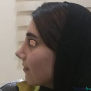 نمونه عمل بینی دکتر شهرام قاسم بگلو 2