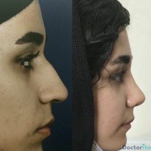 نمونه عمل بینی دکتر شهرام قاسم بگلو 4