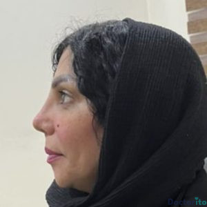 نمونه عمل بینی دکتر شهرام قاسم بگلو 5