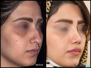 نمونه عمل بینی دکتر شهریار یحیوی 3
