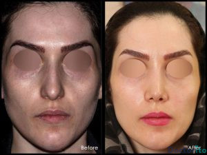 نمونه عمل بینی دکتر شهریار یحیوی 5