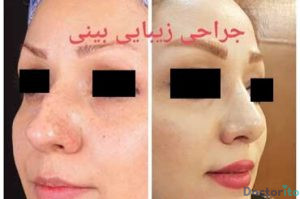 نمونه عمل بینی دکتر عباس نوروزی (1)