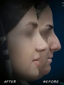 نمونه عمل بینی دکتر علی بصام (3)