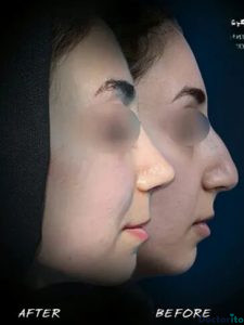 نمونه عمل بینی دکتر علی بصام (4)