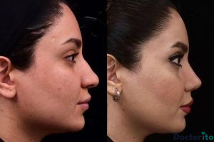 نمونه عمل بینی دکتر علی جاودانی (3)