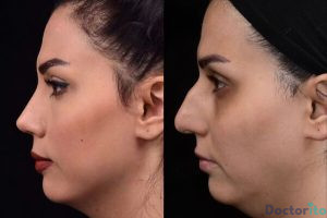 نمونه عمل بینی دکتر علی جاودانی (5)