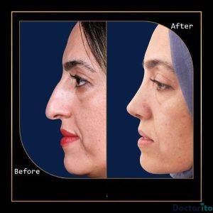 نمونه عمل بینی دکتر علی عقیلی0