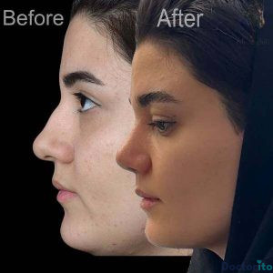 نمونه عمل بینی دکتر علی عقیلی1