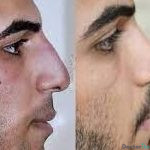 نمونه عمل بینی دکتر علی قاضی پور (3)