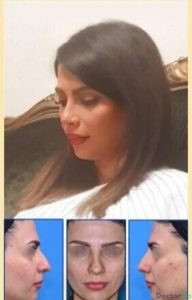 نمونه عمل بینی دکتر علیرضا محبی (3)