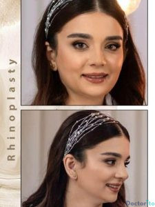 نمونه عمل بینی دکتر علیرضا محبی6