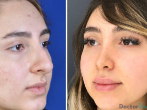 نمونه عمل بینی دکتر فرهود گوراوانچی (5)