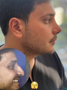 نمونه عمل بینی دکتر فریناز کلاهی 3