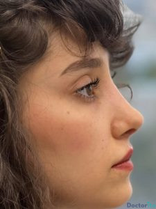 نمونه عمل بینی دکتر فریناز کلاهی 4