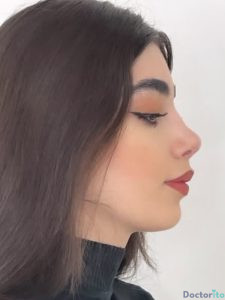 نمونه عمل بینی دکتر فریناز کلاهی 5
