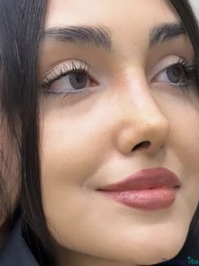 نمونه عمل بینی دکتر فریناز کلاهی 6