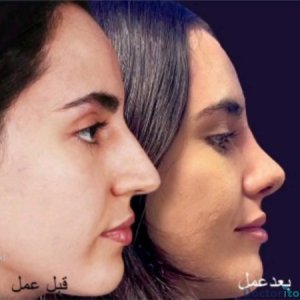 نمونه عمل بینی دکتر مهرداد نهائی (1)
