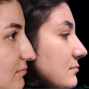 نمونه عمل بینی دکتر مهرداد نهائی (3)