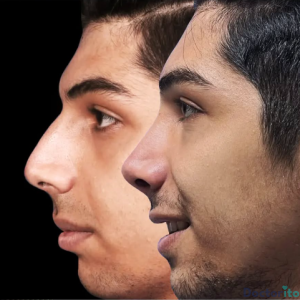 نمونه عمل بینی دکتر مهرداد نهائی (5)