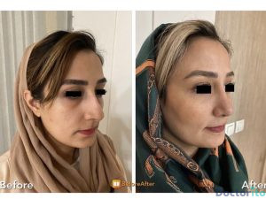 نمونه عمل بینی دکتر هاشم پویا 2