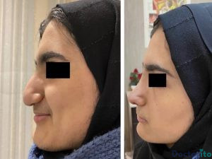 نمونه عمل بینی دکتر هاشم پویا 3