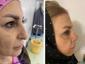نمونه عمل بینی دکتر هاشم پویا 4