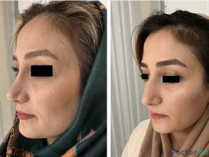 نمونه عمل بینی دکتر هاشم پویا 5