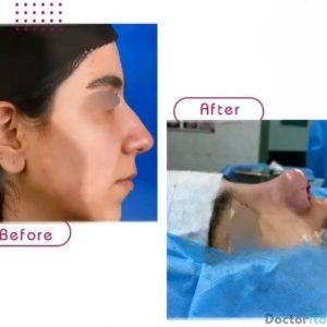 نمونه عمل بینی دکتر ژیلا محمدی آذر (1)