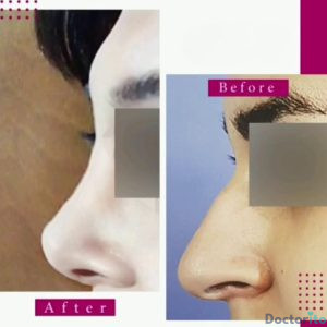 نمونه عمل بینی دکتر ژیلا محمدی آذر (2)
