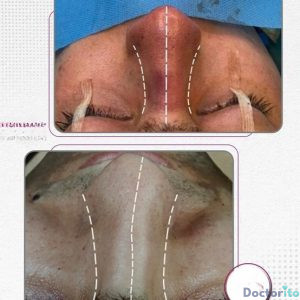 نمونه عمل بینی دکتر ژیلا محمدی آذر (3)