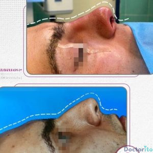 نمونه عمل بینی دکتر ژیلا محمدی آذر (4)
