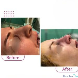 نمونه عمل بینی دکتر ژیلا محمدی آذر (5)