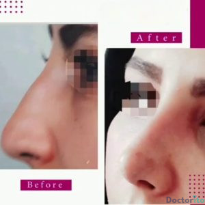 نمونه عمل بینی دکتر ژیلا محمدی آذر (6)