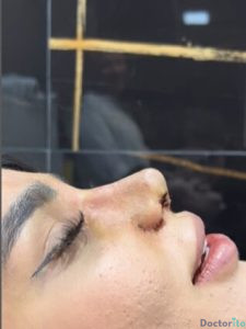 نمونه عمل بینی دکتر کامبیز ایزد پناه3