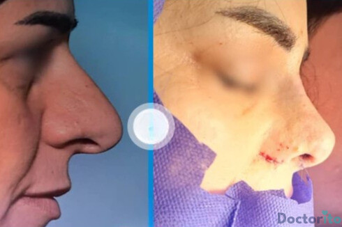 نمونه عمل بینی دکتر سلیمان زندی3