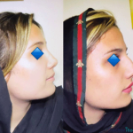نمونه عمل بینی دکتر ابراهیم فهیم نیا