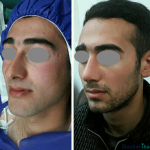 نمونه عمل بینی دکتر رضا افراه