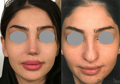 نمونه عمل بینی دکتر بهنام خرمی