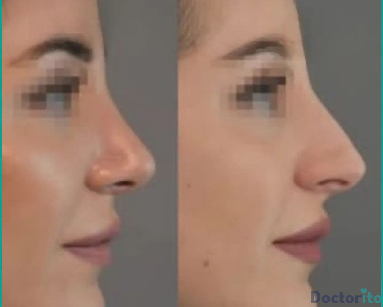 نمونه عمل بینی طبیعی دکتر وحید عین آبادی2