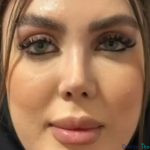 نمونه عمل بینی نیمه فانتزی دکتر آرش سبحان منش3